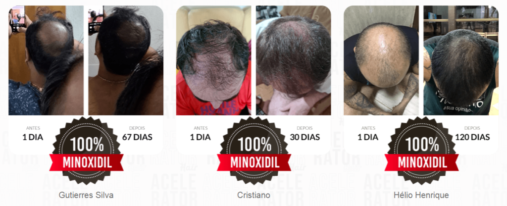 crescer cabelo rápido ACELERATOR HAIR MINOXIDIL ORAL FRETE GRÁTIS