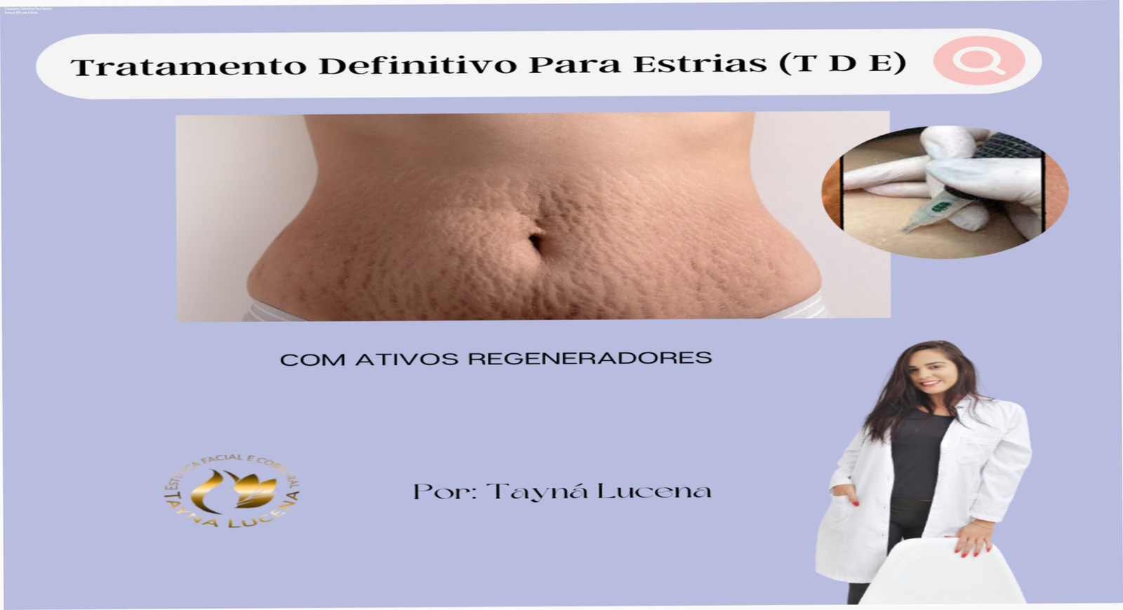 Curso online de tratamento definitivo para estrias com método de regeneração dérmica