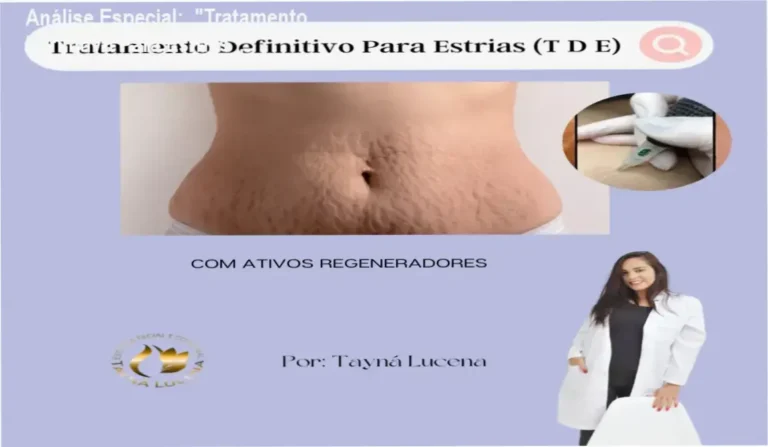 Capa informativa sobre o tema "Tratamento Definitivo Para Estrias",