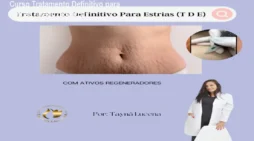 Curso Tratamento Definitivo para Estrias – Reduza Marcas