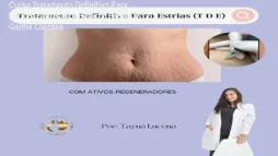 Curso Tratamento Definitivo Para Estrias – Aprenda a Reduzir Estrias e Ganhe Clientes