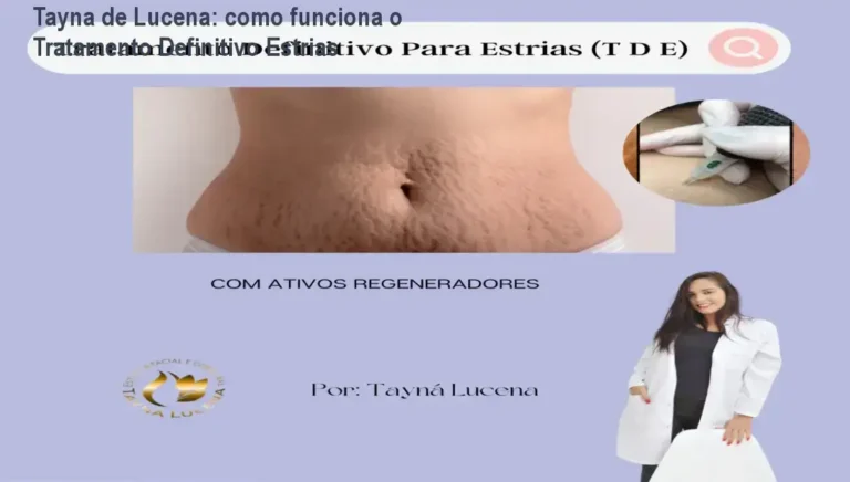Tratamento Definitivo Para Estrias Tayna de Lucena bastidores e funcionamento interno